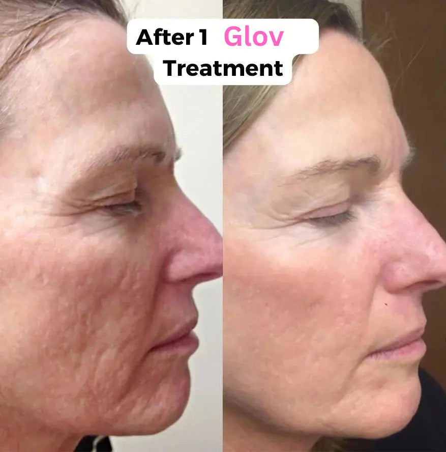Glov Micro Infusion System